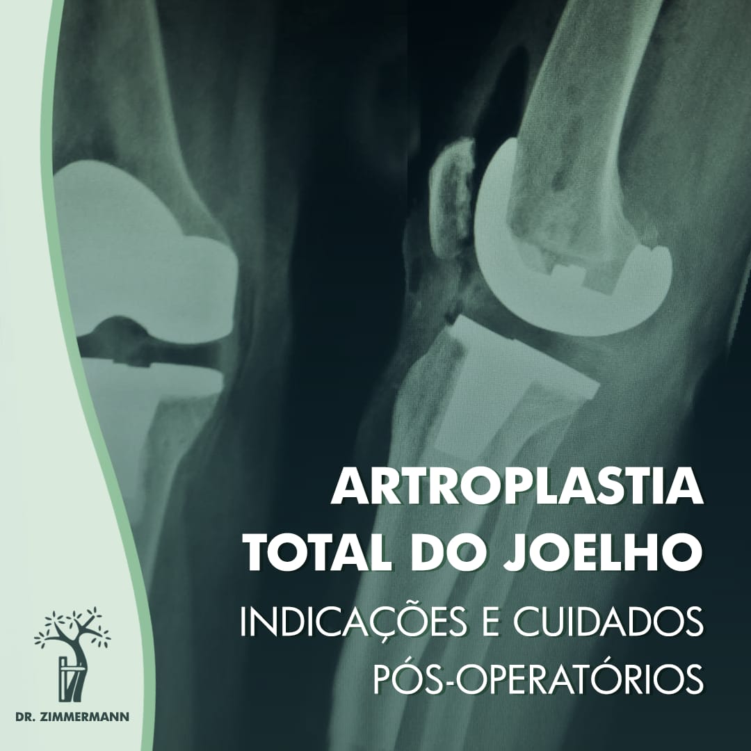 Artroplastia total do joelho indicações e cuidados pós operatórios Dr José Mauro Zimmermann